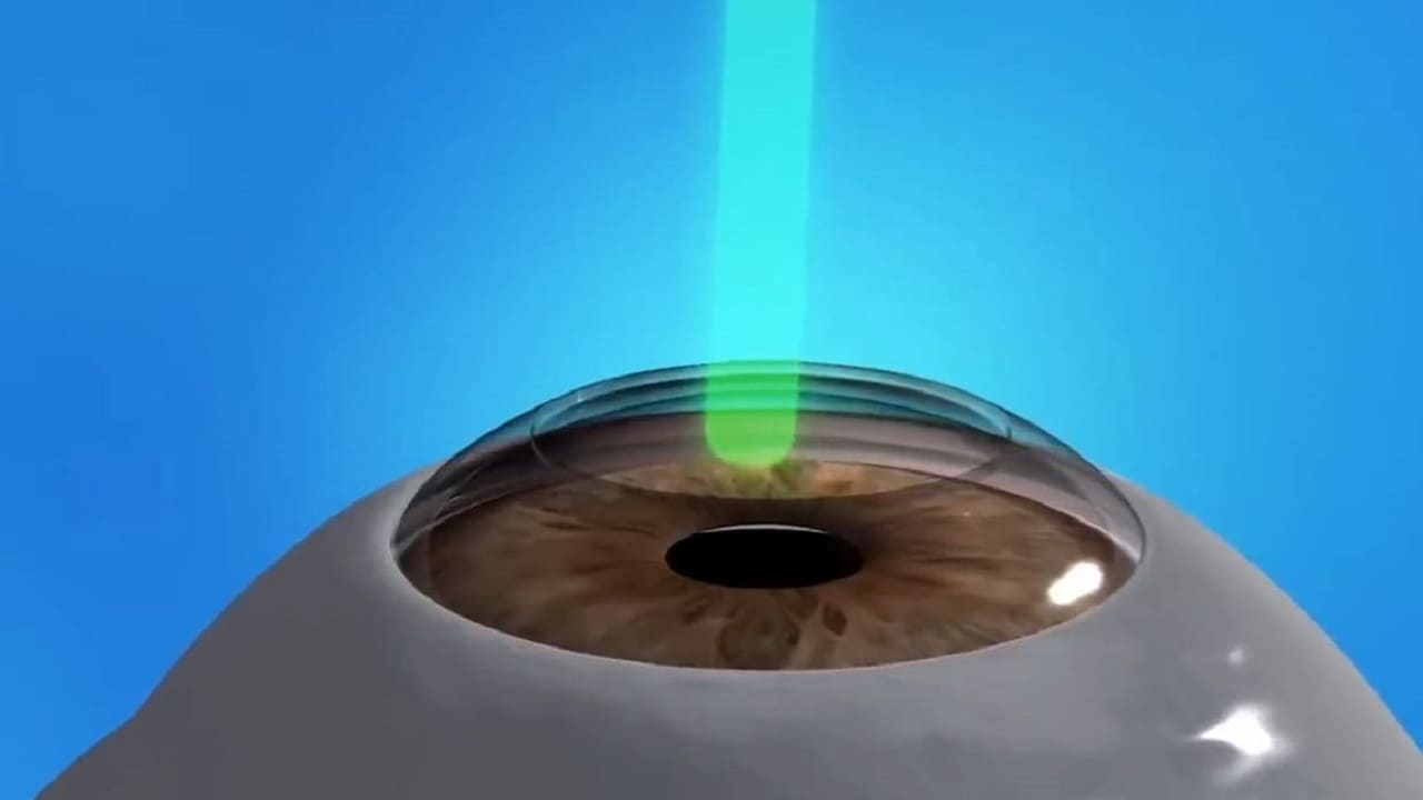 Коррекция зрения лазером